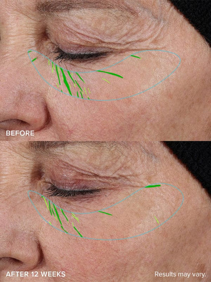 Needle-less Growth Factor Serum